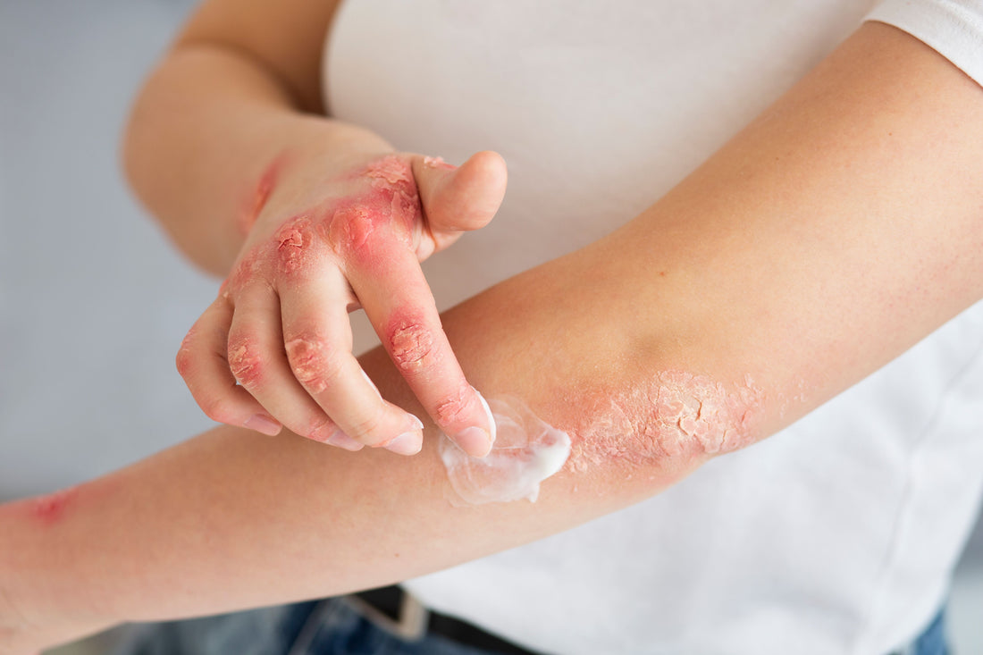Eczema: Causes, Symptoms, and Treatment